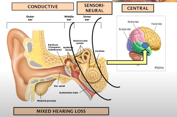 Eartalk July 2021 Understanding Hearing Loss 1040